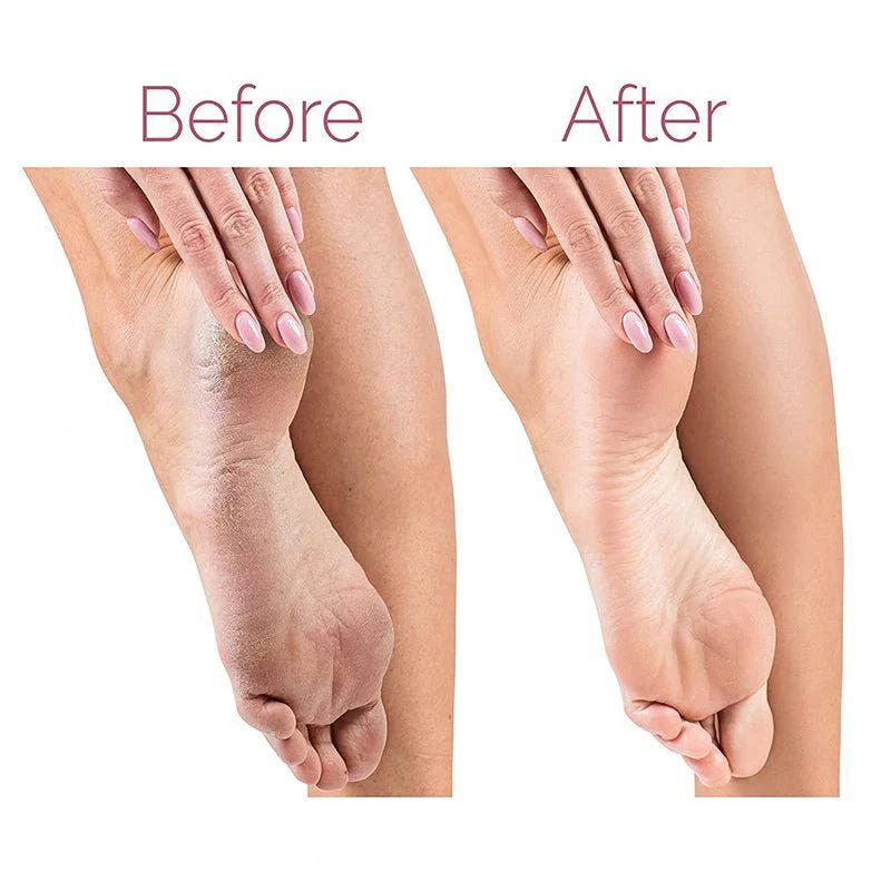 Electric Pedicure Foot File Callus Remov...